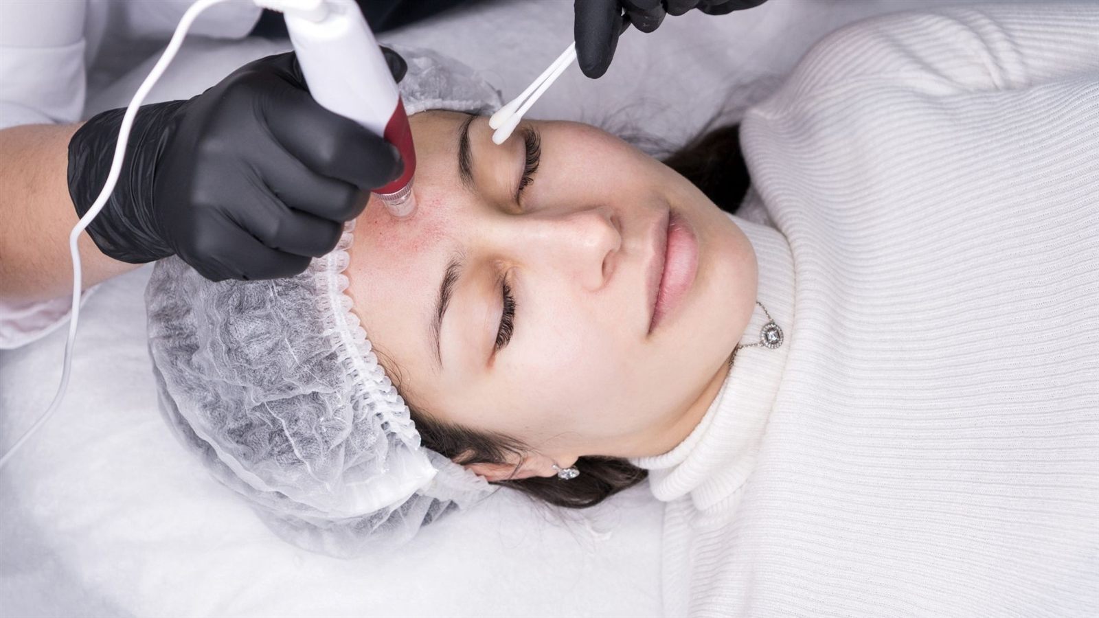 Microneedling in Boston, MA service at A Smith Allure in Boston