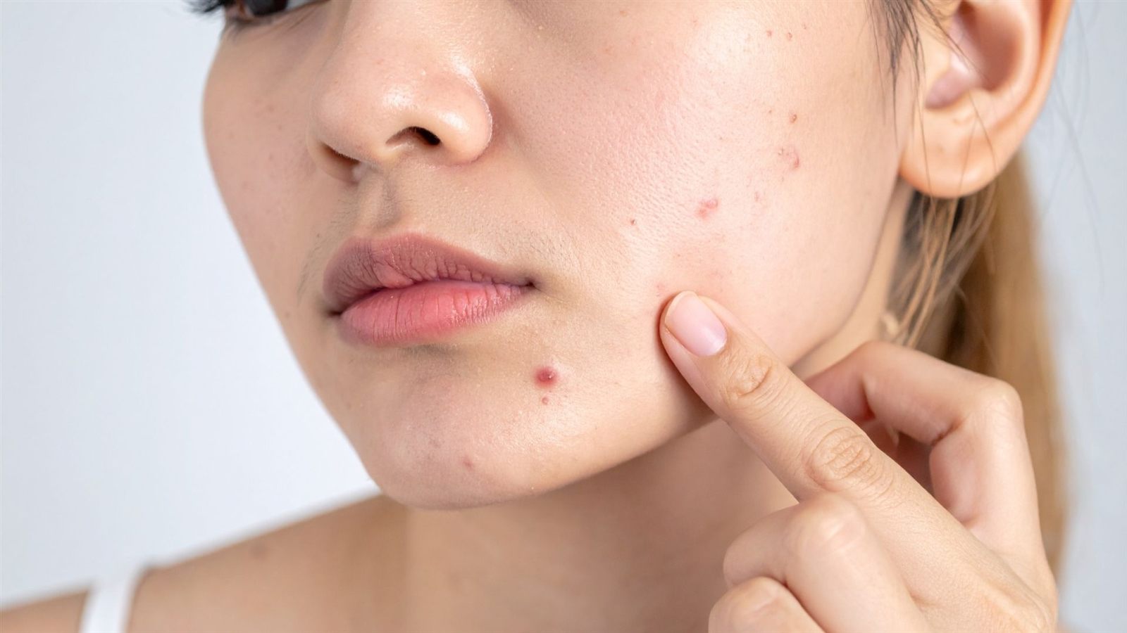 Acne Treatment in Boston, MA by A Smith Allure